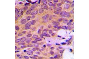 Immunohistochemical analysis of Ataxin 2 staining in human breast cancer formalin fixed paraffin embedded tissue section. (Ataxin 2 Antikörper  (Center))
