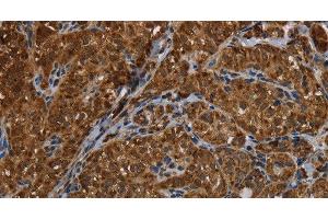 Immunohistochemistry of paraffin-embedded Human thyroid cancer using HSD17B13 Polyclonal Antibody at dilution of 1:30 (HSD17B13 Antikörper)