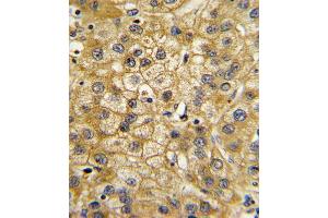 Formalin-fixed and paraffin-embedded human hepatocarcinoma with ADIPOR1 Antibody (C-term), which was peroxidase-conjugated to the secondary antibody, followed by DAB staining. (Adiponectin Receptor 1 Antikörper  (C-Term))