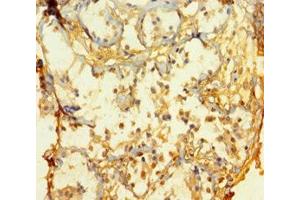 Immunohistochemistry of paraffin-embedded human breast cancer using ABIN7165112 at dilution of 1:100 (ATOH1 Antikörper  (AA 1-354))