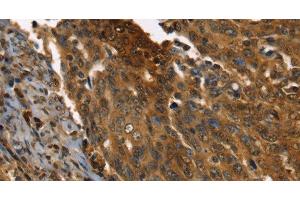 Immunohistochemistry of paraffin-embedded Human cervical cancer using PPIA Polyclonal Antibody at dilution of 1:35 (PPIA Antikörper)
