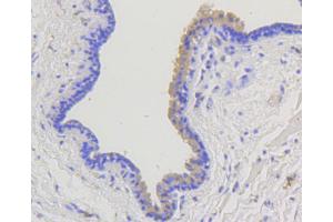 Immunohistochemistry of paraffin-embedded human mammary cancer using ARRB1 antibody (ABIN5996907) at dilution of 1/100 (40x lens). (beta Arrestin 1 Antikörper)