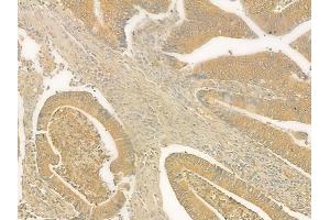 ABIN6265876 and ABIN6276800 at 1/100 staining human colon carcinoma by IHC-P.