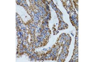Immunohistochemistry of paraffin-embedded human gastric cancer using MRPL28 antibody. (MRPL28 Antikörper  (AA 1-256))
