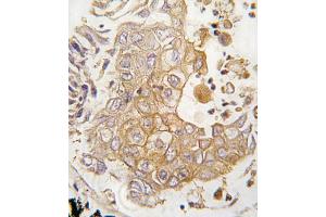 Formalin-fixed and paraffin-embedded human lung carcinoma tissue reacted with CYP1A1 antibody (C-term), which was peroxidase-conjugated to the secondary antibody, followed by DAB staining. (CYP1A1 Antikörper  (C-Term))