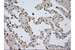 Immunohistochemical staining of paraffin-embedded Adenocarcinoma of breast tissue using anti-NTRK3 mouse monoclonal antibody. (NTRK3 Antikörper)
