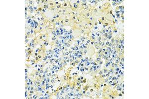 Immunohistochemistry of paraffin-embedded human lung cancer using SLC25A1 antibody (ABIN4905187) at dilution of 1:100 (40x lens). (Slc25a1 Antikörper)
