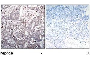 Immunohistochemical analysis of paraffin-embedded human breast carcinoma tissue using NFKBIB polyclonal antibody . (NFKBIB Antikörper)