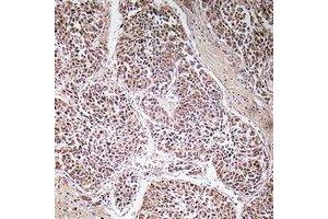 Immunohistochemical analysis of ATP5C1 staining in human liver cancer formalin fixed paraffin embedded tissue section. (ATP5C1 Antikörper)