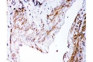 IHC-P: DHFR antibody testing of human lung cancer tissue (Dihydrofolate Reductase Antikörper  (AA 2-187))