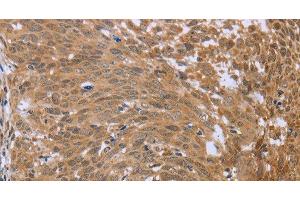 Immunohistochemistry of paraffin-embedded Human cervical cancer using FHL2 Polyclonal Antibody at dilution of 1:40 (FHL2 Antikörper)