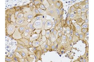 Immunohistochemistry of paraffin-embedded human breast cancer using PDE4D antibody (ABIN3022336, ABIN3022337, ABIN3022338 and ABIN6218749) at dilution of 1:100 (40x lens).