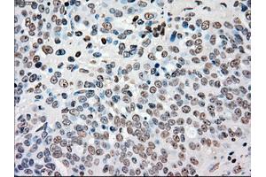 Immunohistochemical staining of paraffin-embedded colon tissue using anti-CHEK2mouse monoclonal antibody. (CHEK2 Antikörper)