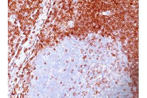 Formalin-fixed, paraffin-embedded human Non-Hodgkin's Lymphoma stained with Bcl-2 Mouse Monoclonal Antibody (SPM117). (Bcl-2 Antikörper  (AA 41-54))