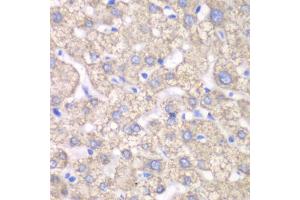 Immunohistochemistry of paraffin-embedded human liver injury using ACAT1 antibody. (ACAT1 Antikörper)