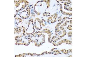 Immunohistochemistry of paraffin-embedded human thyroid cancer using FKBP51/FKBP5 Rabbit mAb (ABIN7267213) at dilution of 1:100 (40x lens). (FKBP5 Antikörper)
