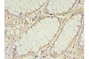 Immunohistochemistry of paraffin-embedded human colon cancer using ABIN7159891 at dilution of 1:100 (TIMM1 (AA 1-90) Antikörper)
