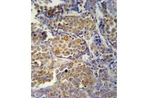 KIR2DS2 Antibody (Center) (ABIN651951 and ABIN2840473) immunohistochemistry analysis in formalin fixed and paraffin embedded human skin carcinoma followed by peroxidase conjugation of the secondary antibody and DAB staining.