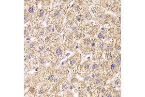 Immunohistochemistry of paraffin-embedded Human liver injury using ST3GAL3 antibody at dilution of 1:100 (x400 lens). (ST3GAL3 Antikörper)