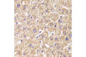 Immunohistochemistry of paraffin-embedded Human liver injury using ST3GAL3 antibody at dilution of 1:100 (x400 lens). (ST3GAL3 Antikörper)