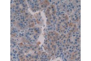 IHC-P analysis of Human Liver Cancer Tissue, with DAB staining. (MUC16 Antikörper  (AA 13977-14117))