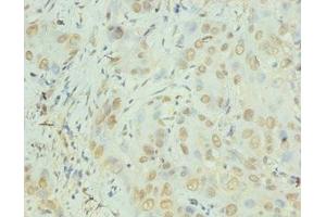 Immunohistochemistry of paraffin-embedded human liver cancer using ABIN7156933 at dilution of 1:100
