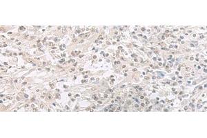 Immunohistochemistry of paraffin-embedded Human liver cancer tissue using ORC1 Polyclonal Antibody at dilution of 1:65(x200)