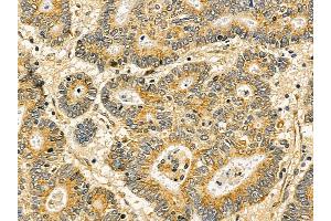 ARRDC2 Mouse Monoclonal Antibody at 1/100 staining human colorectal cancer by IHC-P. (ARRDC2 Antikörper  (C-Term))