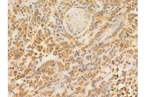 ABIN6260894 and ABIN6266702 at 1/100 staining human Hodgkin lymphoma by IHC-P.