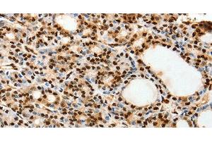 Immunohistochemistry of paraffin-embedded Human thyroid cancer using SPATA20 Polyclonal Antibody at dilution of 1:70 (SPATA20 Antikörper)