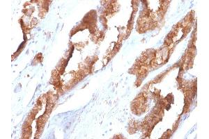 Formalin-fixed, paraffin-embedded human Prostate stained with HSP27 Mouse Monoclonal Antibody (CPTC-HSPB1-2). (HSP27 Antikörper)