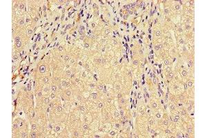 Immunohistochemistry of paraffin-embedded human liver cancer using ABIN7159734 at dilution of 1:100 (MTTP Antikörper  (AA 19-151))
