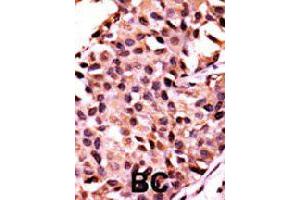 Formalin-fixed and paraffin-embedded human breast cancer tissue reacted with PPP3CC polyclonal antibody  , which was peroxidase-conjugated to the secondary antibody, followed by AEC staining. (PPP3CC Antikörper  (N-Term))