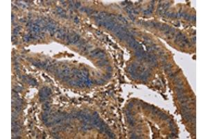 The image on the left is immunohistochemistry of paraffin-embedded Human colon cancer tissue using ABIN7191171(KCNG1 Antibody) at dilution 1/40, on the right is treated with synthetic peptide. (KCNG1 Antikörper)