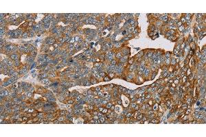 Immunohistochemistry of paraffin-embedded Human cervical cancer using MTFP1 Polyclonal Antibody at dilution of 1:30 (Mtfp1 Antikörper)