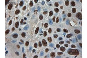 Immunohistochemical staining of paraffin-embedded Adenocarcinoma of breast using anti-AMY2A (ABIN2452539) mouse monoclonal antibody. (AMY2A Antikörper  (AA 300-511))