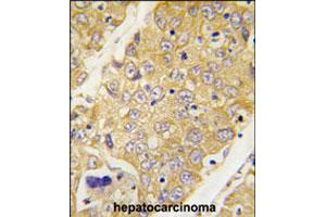 Formalin-fixed and paraffin-embedded human hepatocellular carcinoma reacted with Dtnbp1 polyclonal antibody  , which was peroxidase-conjugated to the secondary antibody, followed by DAB staining. (DTNBP1 Antikörper  (C-Term))
