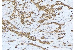 ABIN6275640 at 1/100 staining Human lung cancer tissue by IHC-P. (MTERF Antikörper  (Internal Region))