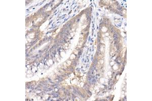 Immunohistochemistry of paraffin-embedded human colon carcinoma using SARA Rabbit mAb (ABIN7271559) at dilution of 1:50 (40x lens). (ZFYVE9 Antikörper)