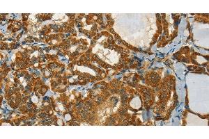 Immunohistochemistry of paraffin-embedded Human thyroid cancer tissue using NPAP1 Polyclonal Antibody at dilution 1:60