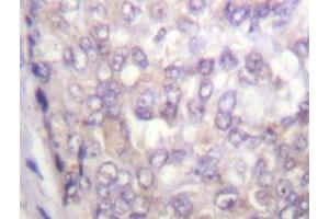 Immunohistochemistry analyzes of C-Raf antibody in paraffin-embedded human breast carcinoma tissue. (RAF1 Antikörper)