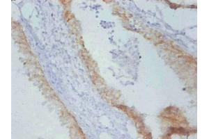 Immunohistochemistry of paraffin-embedded Rat prostate cancer using ABIN7179094 at dilution of 1:100. (TIMP1 Antikörper)