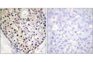 Immunohistochemistry analysis of paraffin-embedded human breast carcinoma, using CHOP (Phospho-Ser30) Antibody.