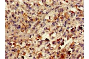 Immunohistochemistry of paraffin-embedded human melanoma using ABIN7154456 at dilution of 1:100 (PLA2G1 (AA 43-165) Antikörper)