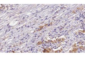 ABIN6272632 at 1/100 staining Human liver cancer tissue by IHC-P.
