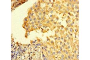 Immunohistochemistry of paraffin-embedded human breast cancer using ABIN7168626 at dilution of 1:100 (STIL Antikörper  (AA 388-637))
