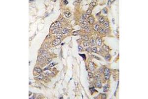 Formalin-fixed and paraffin-embedded human breast carcinoma tissue reacted with CASC3 Antibody (C-term) , which was peroxidase-conjugated to the secondary antibody, followed by DAB staining. (CASC3 Antikörper  (C-Term))