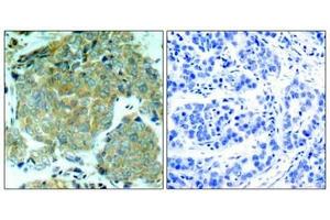 Immunohistochemical analysis of paraffin-embedded human breast carcinoma tissue using eIF2α (Phospho-Ser51) Antibody (left) or the same antibody preincubated with blocking peptide (right). (EIF2S1 Antikörper  (pSer51))