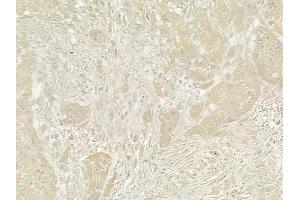ABIN6260408 and ABIN6273204 at 1/100 staining human tongue carcinoma by IHC-P.