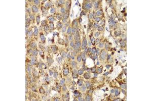 Immunohistochemistry of paraffin-embedded human lung cancer using SHMT2 antibody at dilution of 1:100 (400x lens). (SHMT2 Antikörper)